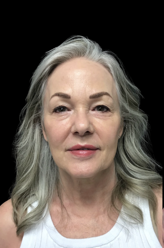 Client before non-surgical facial rejuvenation at Juvly Aesthetics
