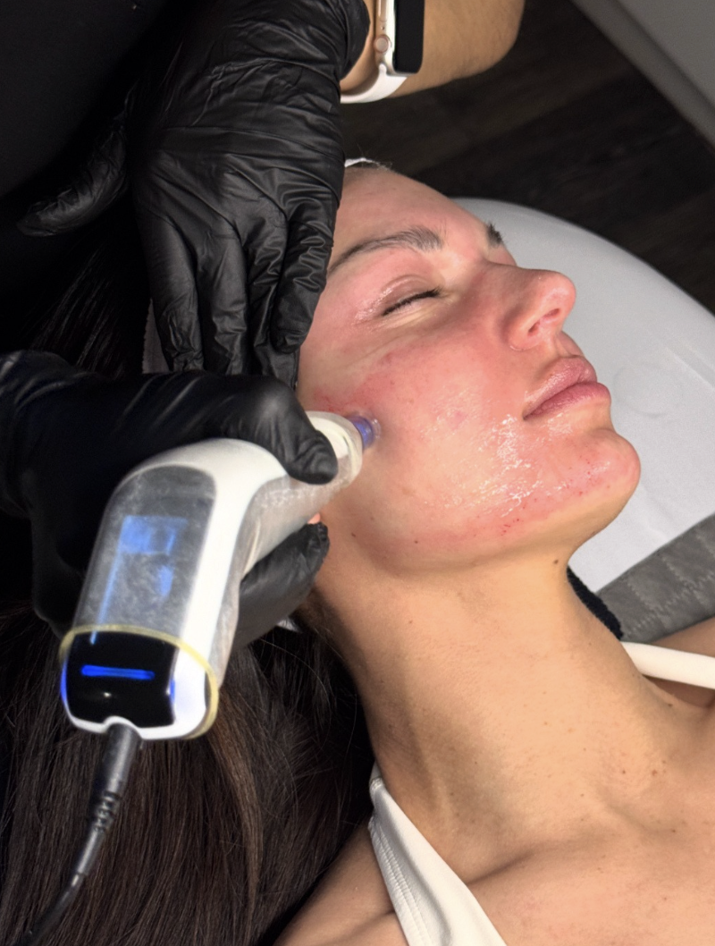 Standard Microneedling