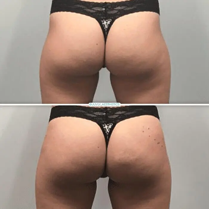 butt-sculptra