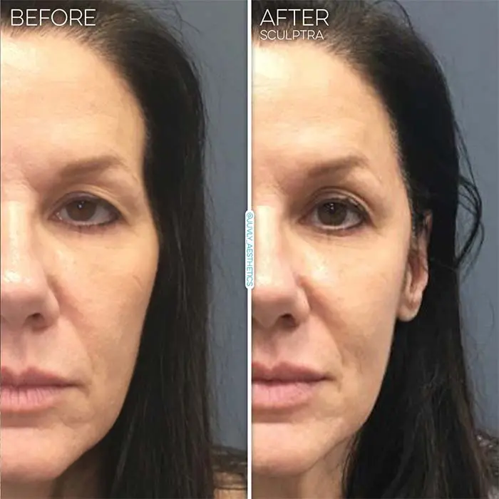 collagen-stimulator-sculptra