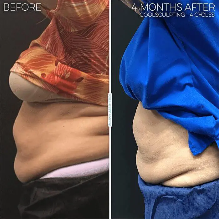 coolsculpting-fat-reduction-belly