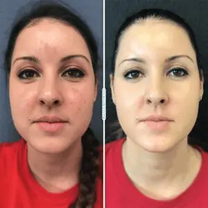 laser-photofacial-face