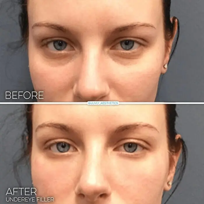 undereyes-refyne-woman
