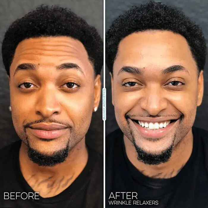 wrinkle-relaxer-dysport-man