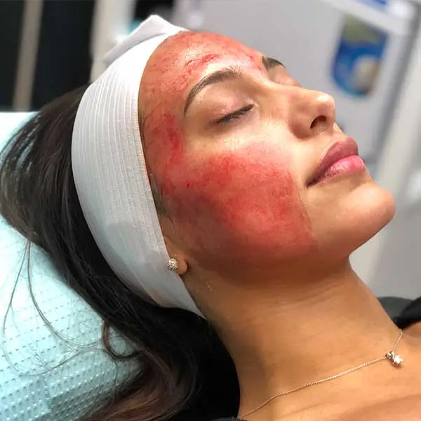 differences-between-chemical-peels-and-microneedling