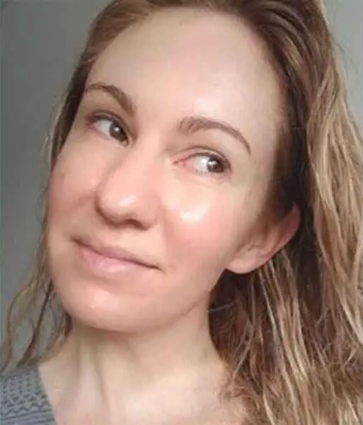 two-peas-microneedling-blog