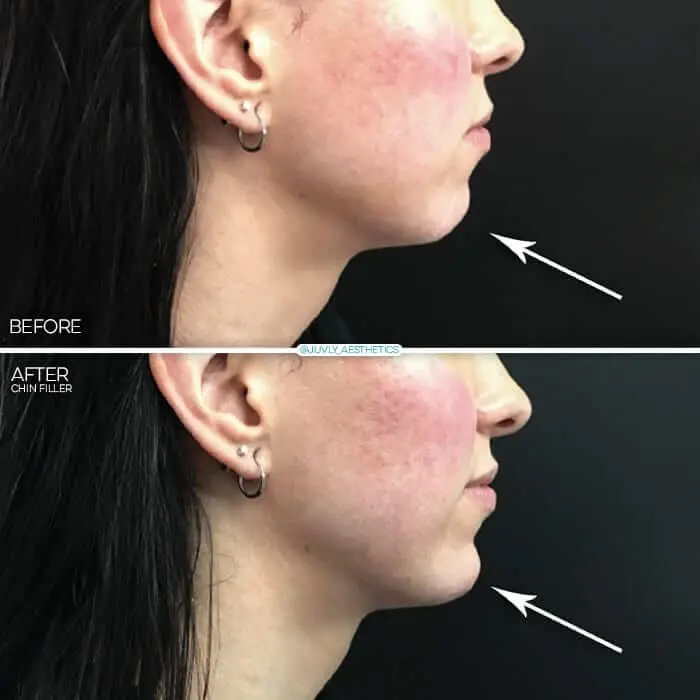 juvly gallery chin filler profile