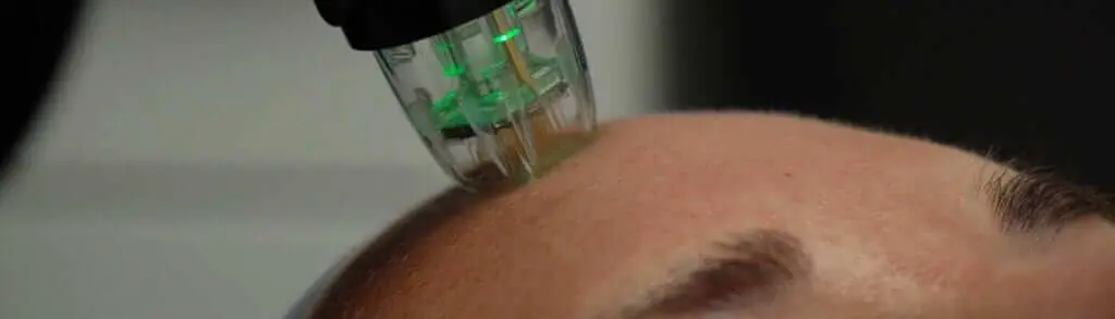 lutronic genius microneedling tip used on the face