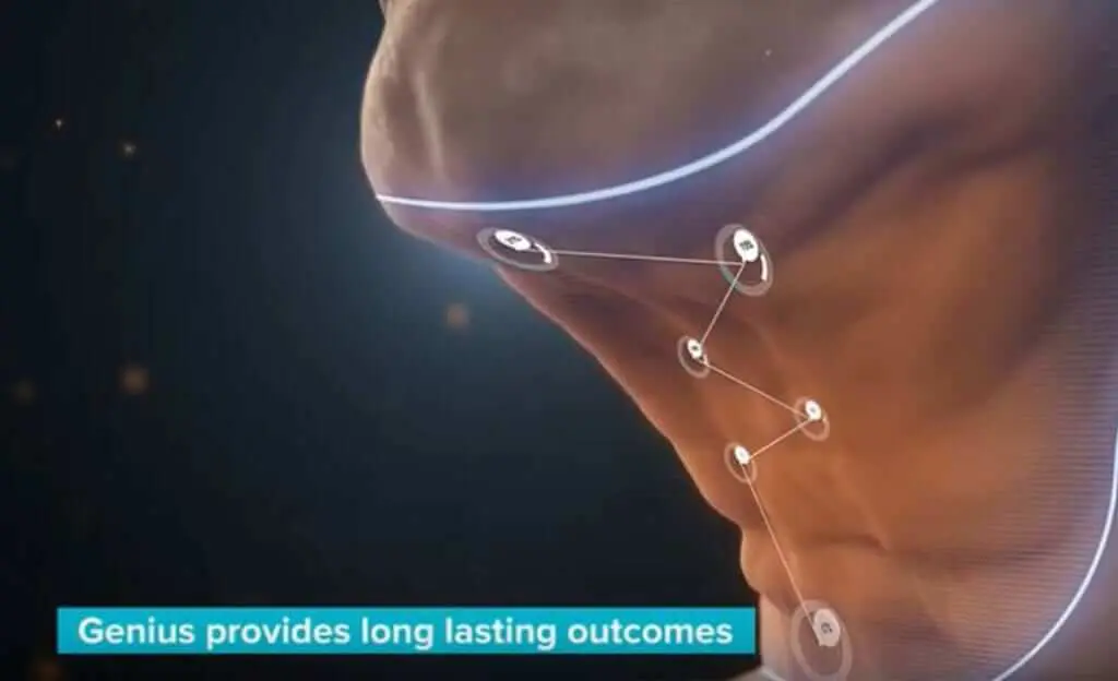 lutronic rf genius microneedling display of neck skin