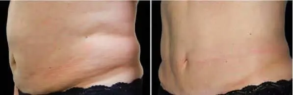 coolsculpting 4-1