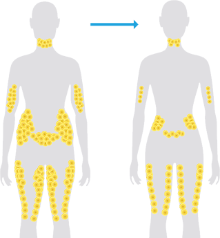 coolsculpting-fat-reduction