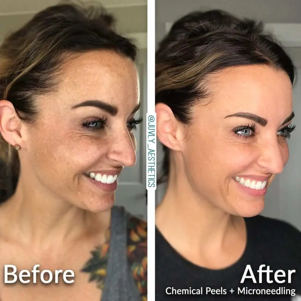Karen Microneedling Chemical Peel 002