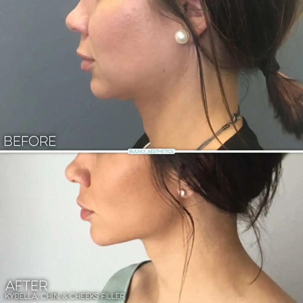 Kybella Cheek Chin Filler 001 Katie (1)