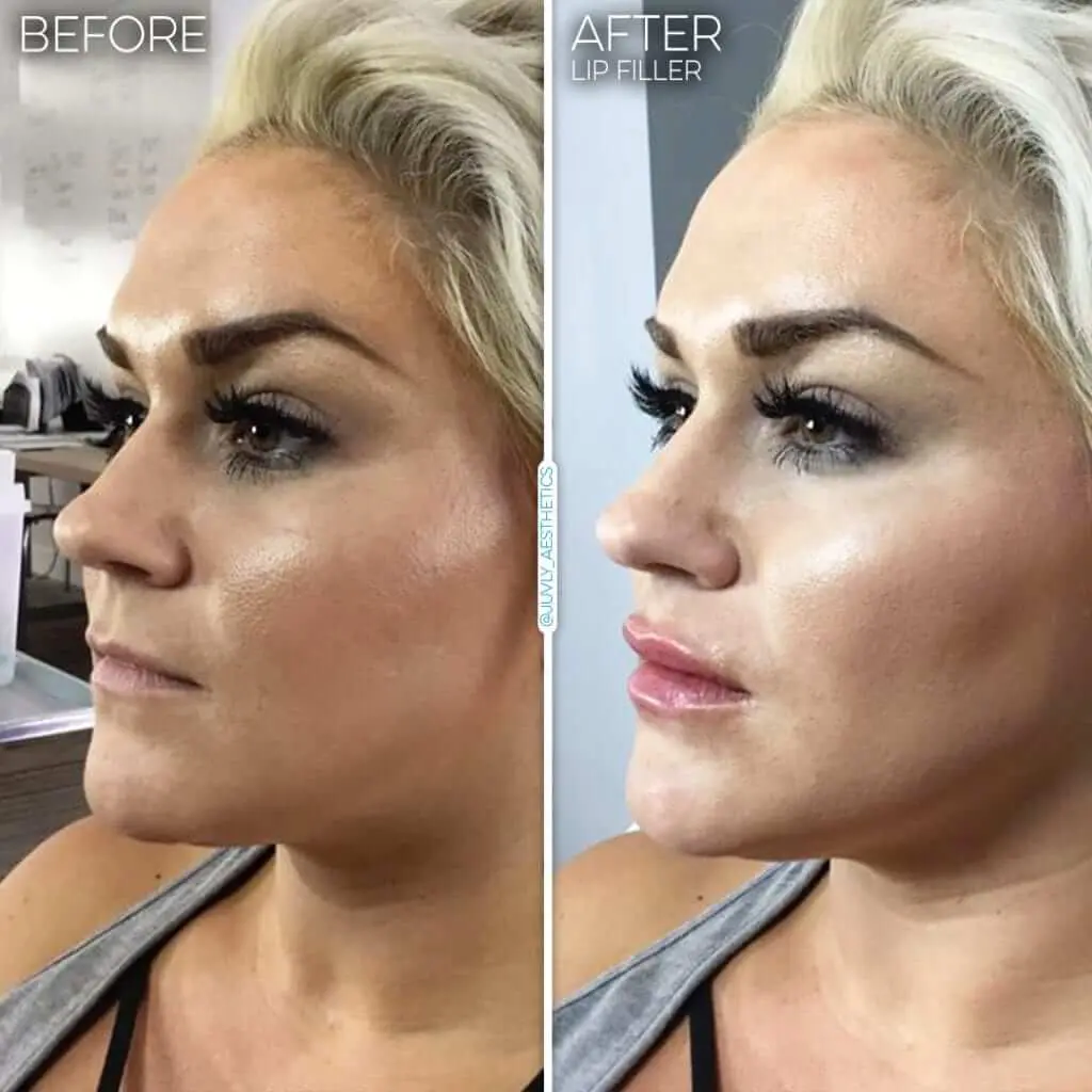 Lip Filler 011 Jessye