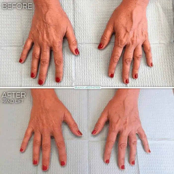 radiesse-hand-filler-woman