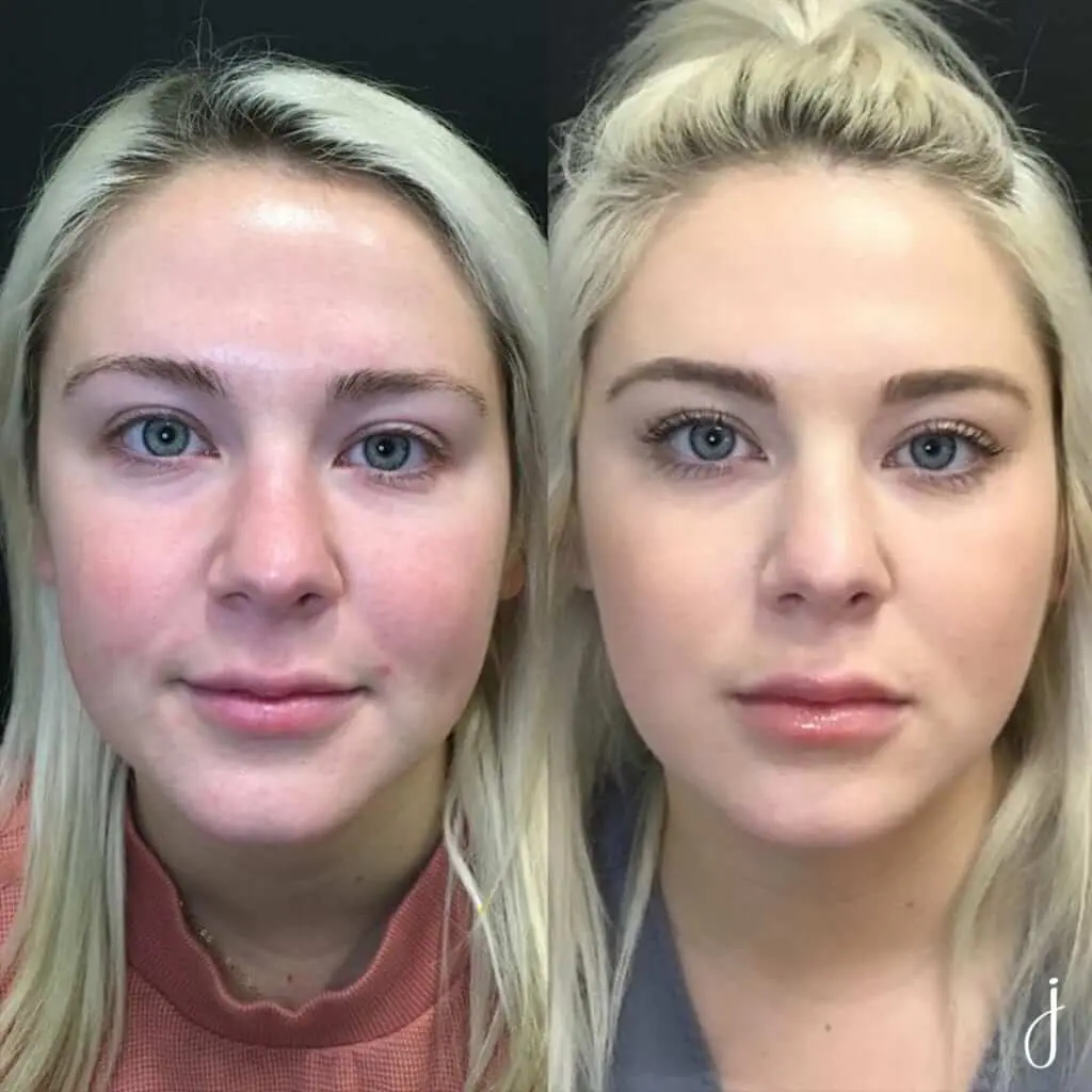 BNA1 Leanne Shinkle chin lip forehead 2 kybella 1 versa plus 21 botox katie pritchard lauren clemons copy