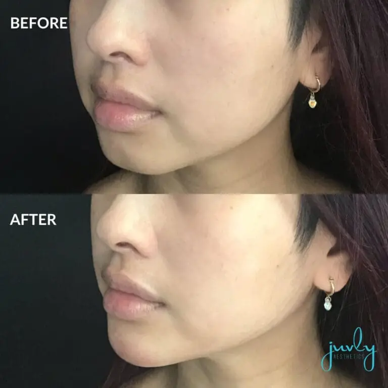 Chin Filler (2)