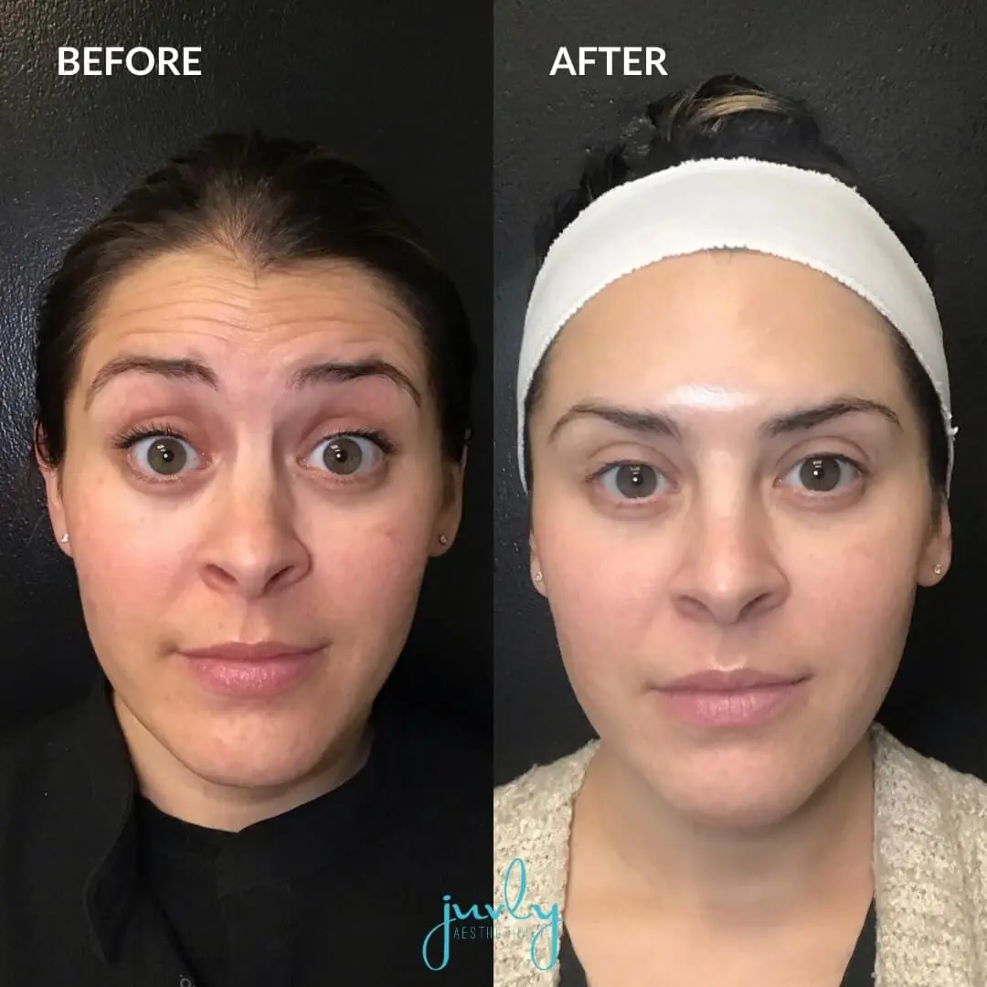 wrinkle relaxers (1)