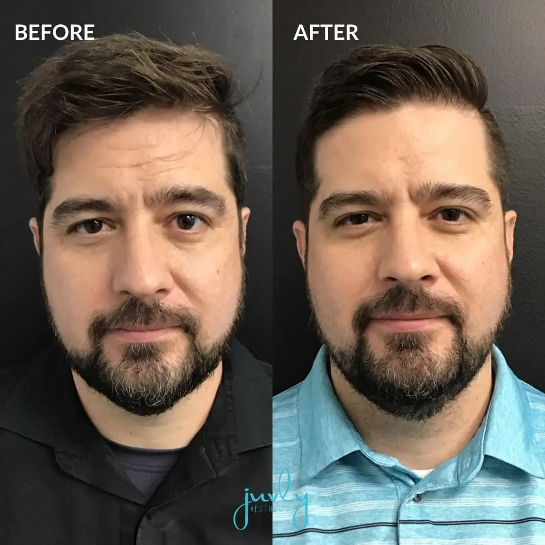 wrinkle relaxers (2)