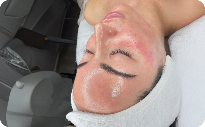 Intensive Chemical Peel