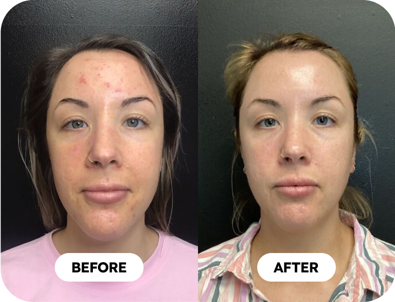 chemical peels before and after