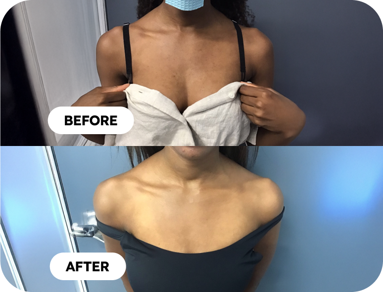 chemical peels before and after