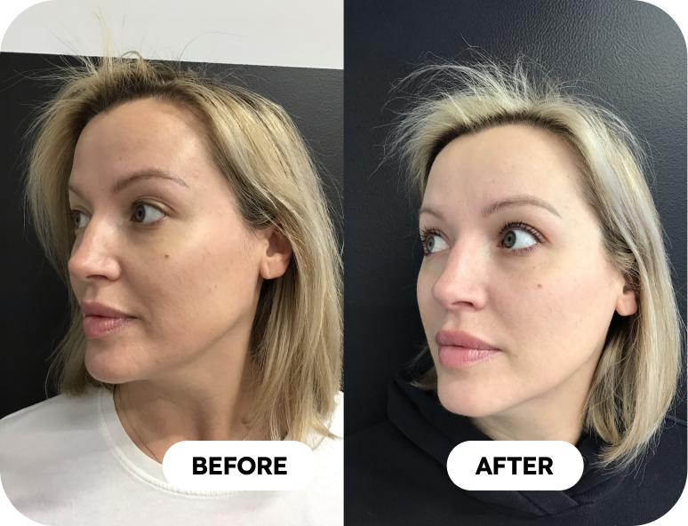 chemical peels before and after