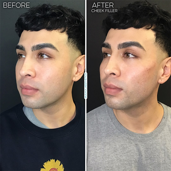 cheek-filler-sale