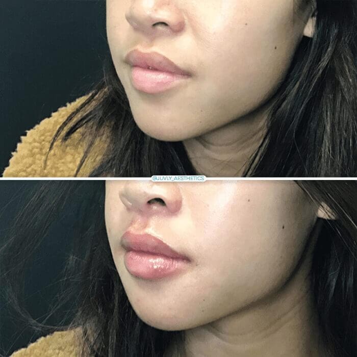 lip-filler-face