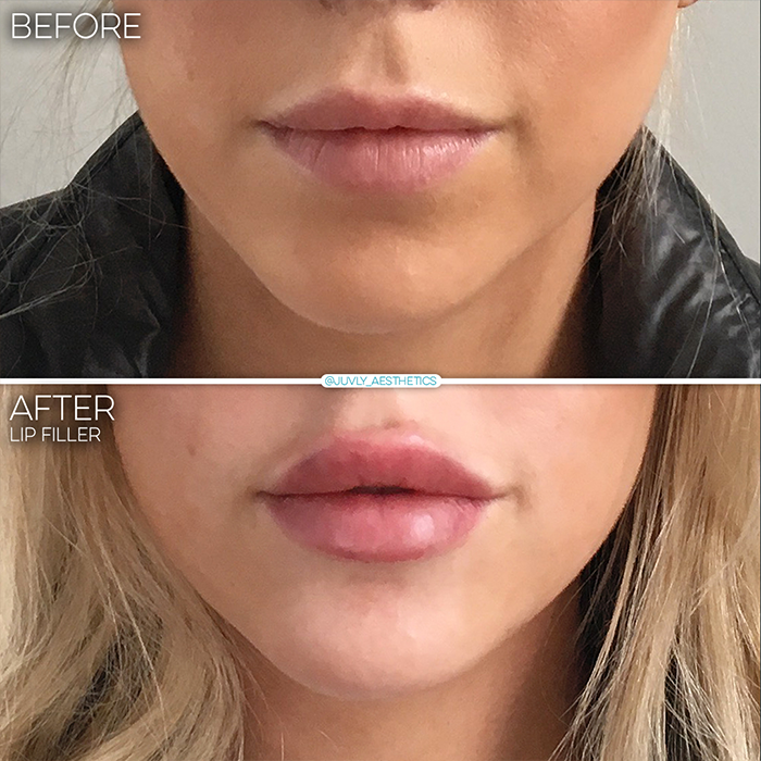 refyne-lips