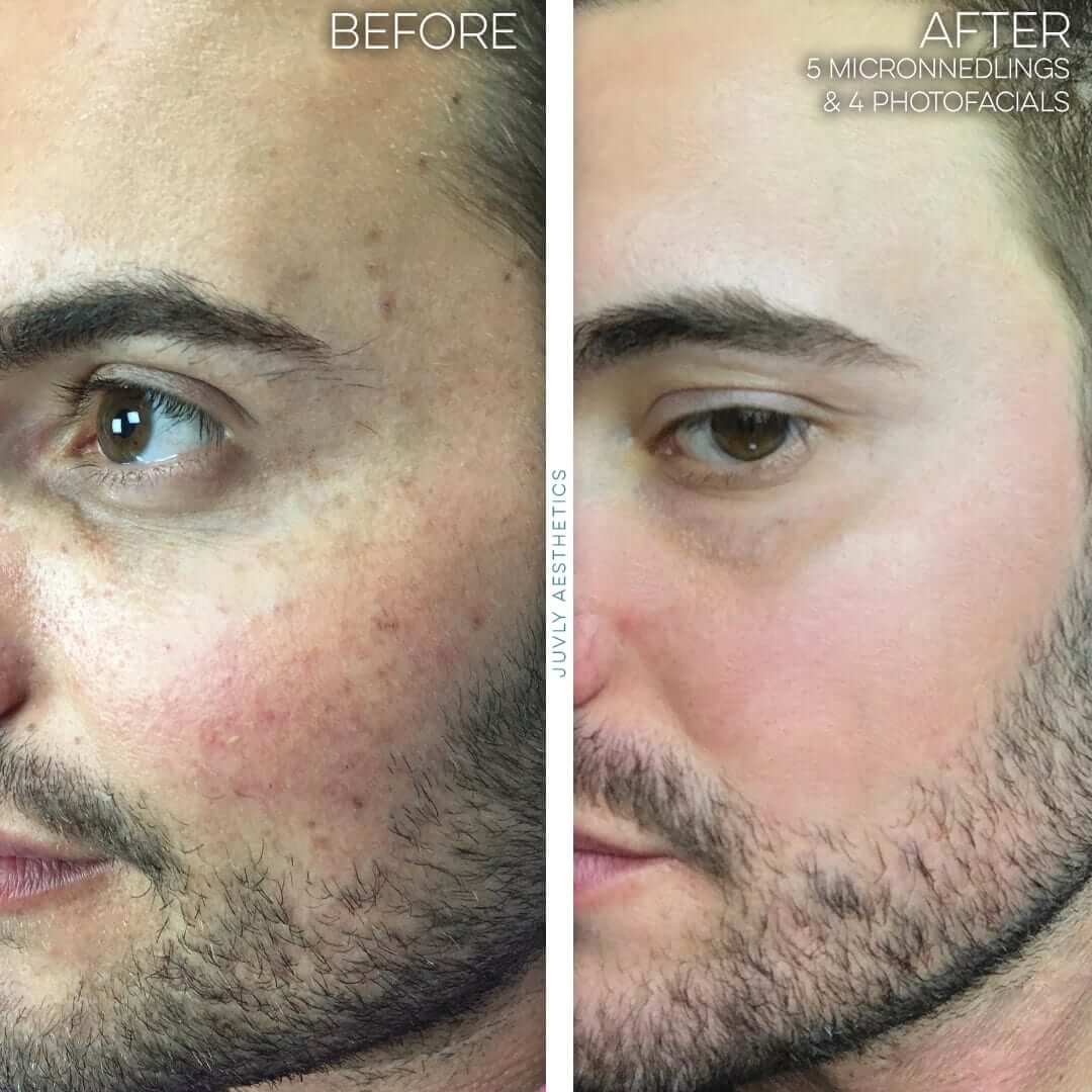 IPL photofacial-man