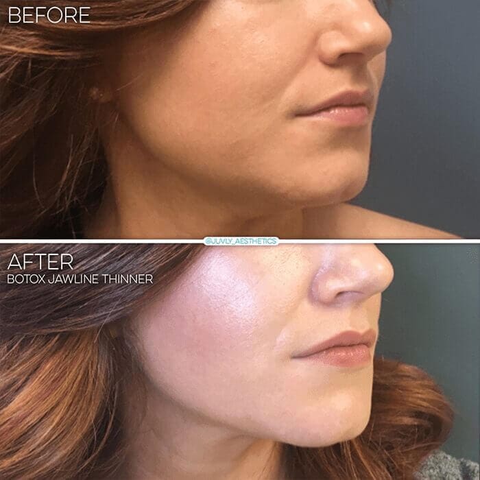 botox-face-thinner-jawline-reduction-woman