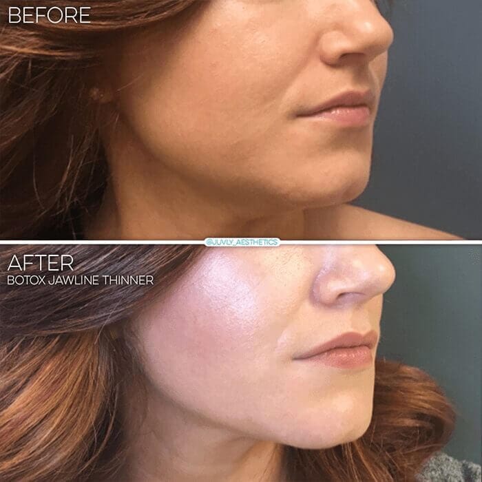 Juvly Aesthetics Juvederm Voluma For Chin Augmentation