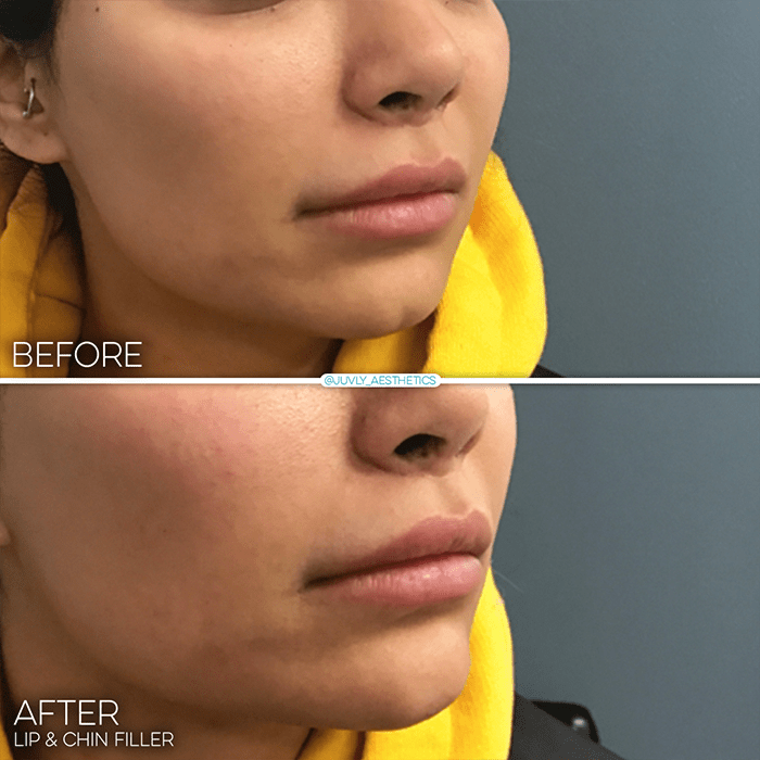 chin-augmentation-woman-lip-filler