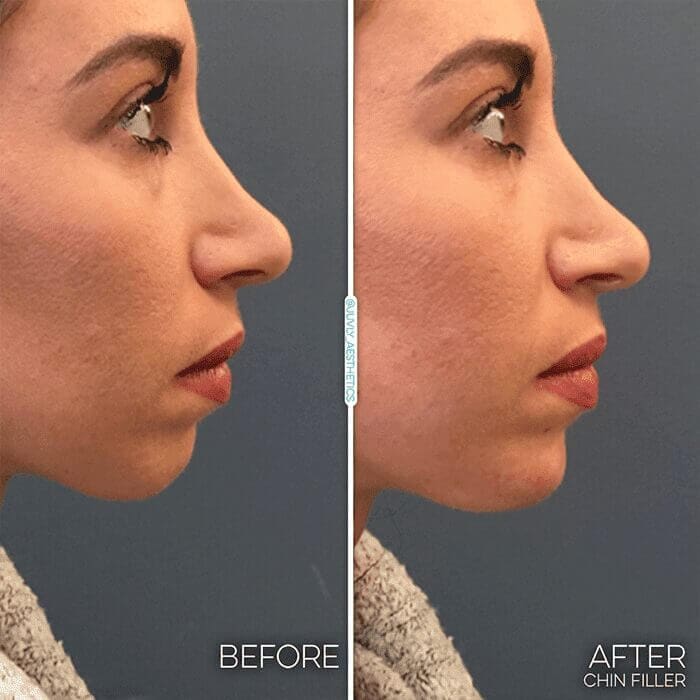 chin-augmentation-woman