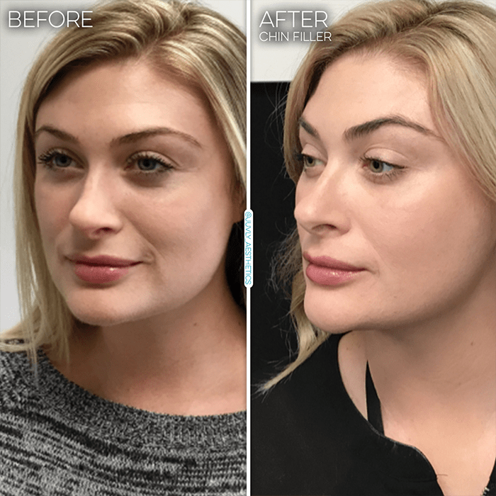 Juvly Aesthetics: Safe Treatments To Enhance And Define Chin Shape