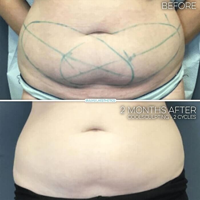 coolsculpting-body-contouring-woman