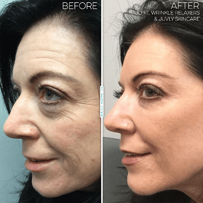 face-jlyft-non-surgical-facelift