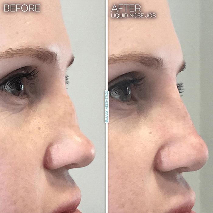liquid-nose-job