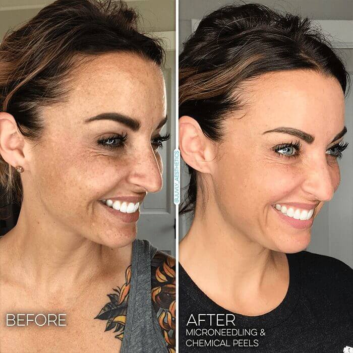 facials-skincare-chemical-peel-microneedling-min facials-skincare-chemical-peel-microneedling-min