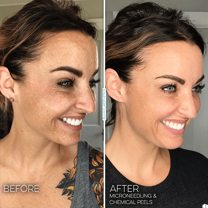facials-skincare-chemical-peel-microneedling-min