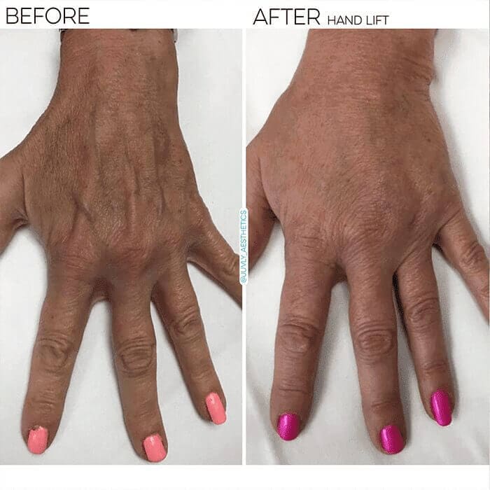 hand-filler-woman-radiesse