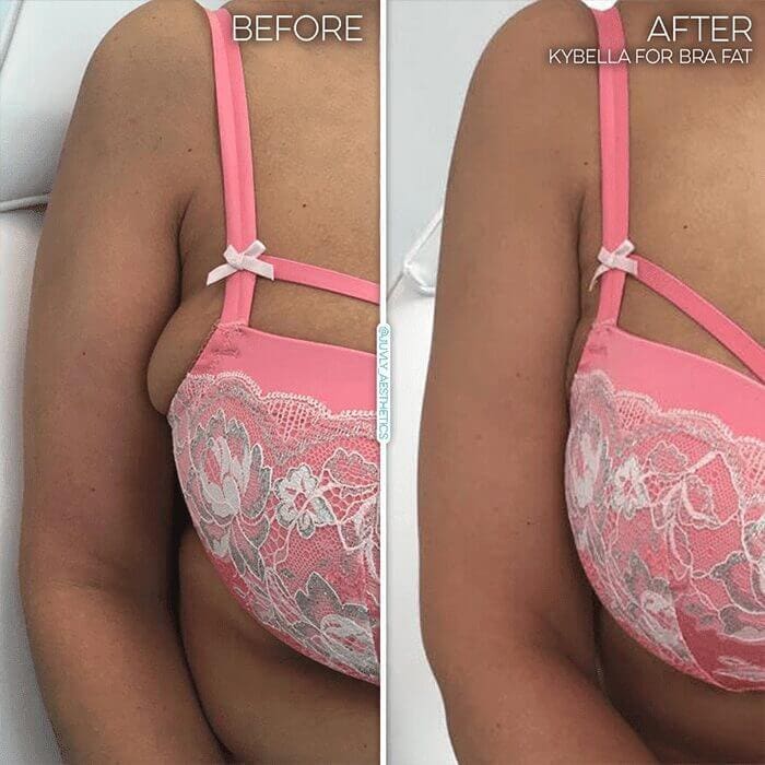 Bra Fat Be Gone: Destroy Excess Fat With Kybella: Rostami OPC