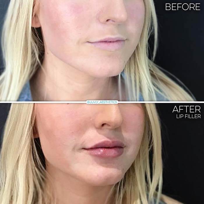 Juvederm Nashville