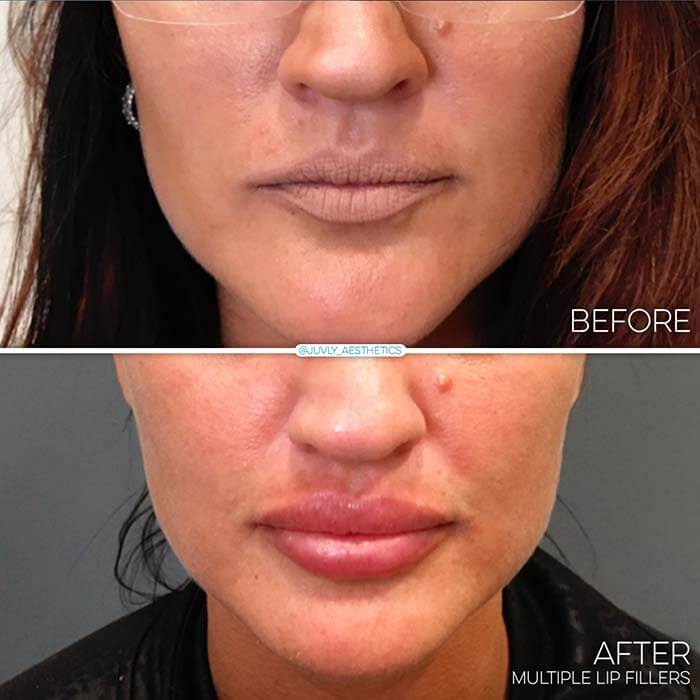 multiple-lip-fillers-juvly