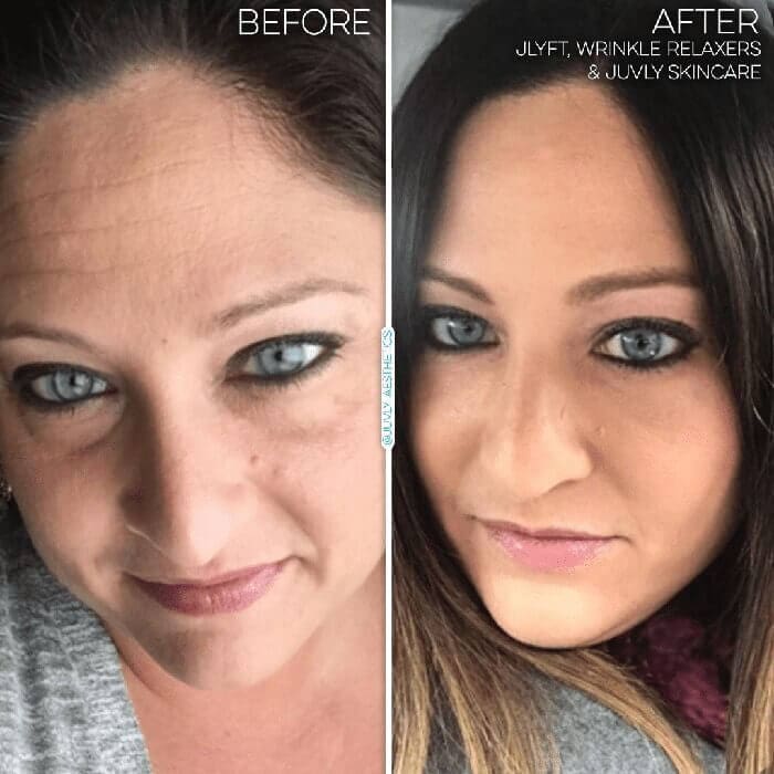 non-surgical-facelift-jlyft-woman non-surgical-facelift-jlyft-woman
