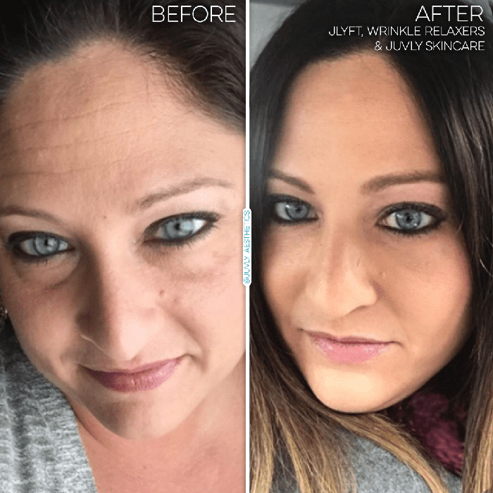 non-surgical-facelift-jlyft-woman