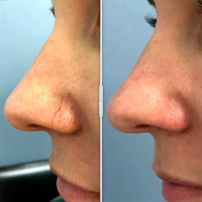 laser hair removal nose hair