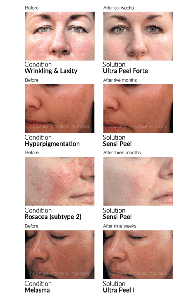 pca-peels-results