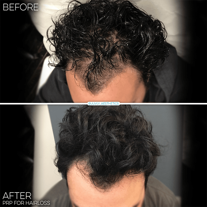 prp-hairloss-results-men